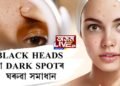 Black heads বা DARK SPOTৰ ঘৰুৱা সমাধান