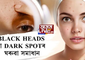 Black heads বা DARK SPOTৰ ঘৰুৱা সমাধান