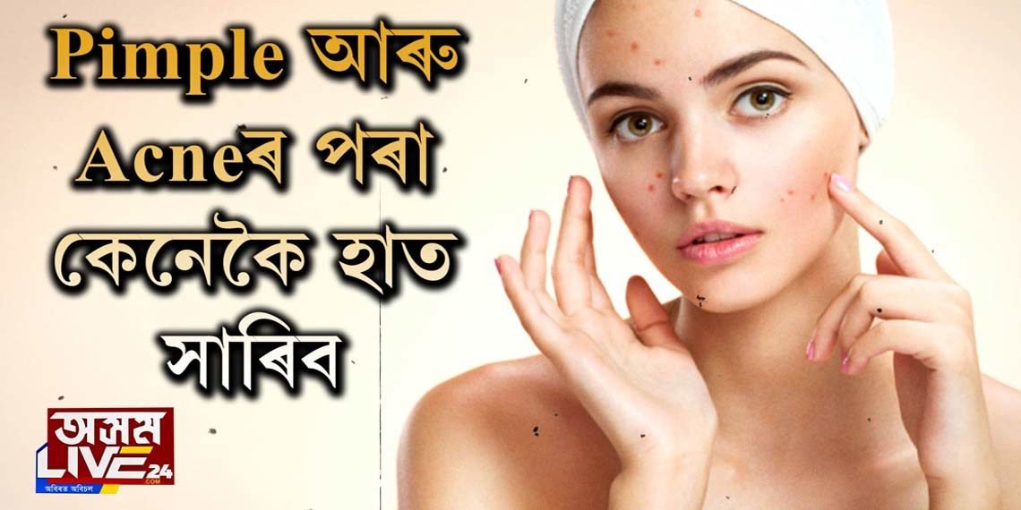 Acne #Pimple Problem হৈছে নেকি আপোনাৰ Skinত?