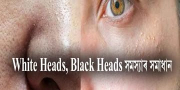White Heads, Black Headsৰ পৰা কেনেকৈ পৰিত্ৰাণ লাভ কৰিব?