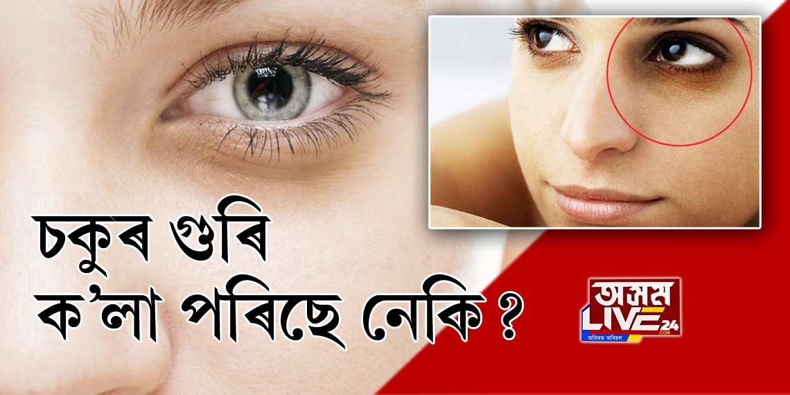 DARK CIRCLES পৰিছে নেকি আপোনাৰ চকুৰ তলত?