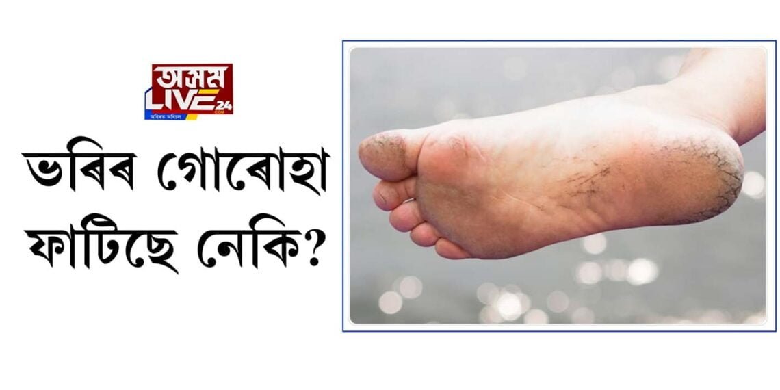 ভৰিৰ গোৰোহা ফাটিছে নেকি?