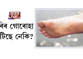ভৰিৰ গোৰোহা ফাটিছে নেকি?