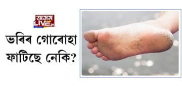ভৰিৰ গোৰোহা ফাটিছে নেকি?
