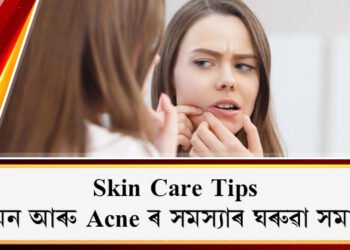 Skin Care Tips: শালমন আৰু Acne ৰ সমস্যাই মুখখনৰ উজ্জ্বলতা নাইকিয়া কৰিছে নেকি? ব্যৱহাৰ কৰক এইকেইটা ঘৰুৱা Tips