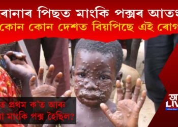 কৰোনাৰ পিছত মাংকি পক্সৰ আতংক! কোন কোন দেশত বিয়পিছে এই ৰোগ?