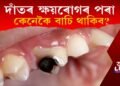 দাঁতৰ ক্ষয়ৰোগৰ পৰা কেনেকৈ বাচি থাকিব?