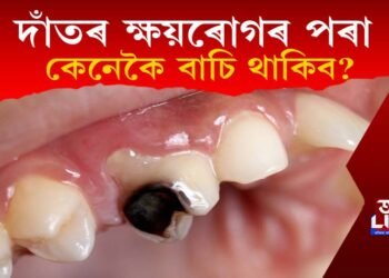 দাঁতৰ ক্ষয়ৰোগৰ পৰা কেনেকৈ বাচি থাকিব?