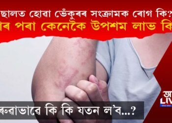 ছালত হোৱা ভেঁ‌কুৰৰ সংক্ৰামক ৰোগৰ পৰা কেনেকৈ উপশম লাভ কৰিব?