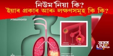 নিউম’নিয়া কি? ইয়াৰ প্ৰকাৰ আৰু লক্ষণসমূহ কি কি?