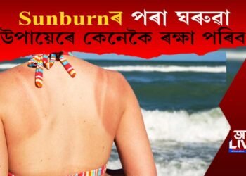 Sunburnৰ পৰা ঘৰুৱা উপায়েৰে কেনেকৈ ৰক্ষা পৰিব?
