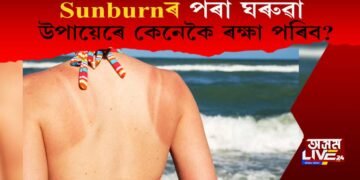 Sunburnৰ পৰা ঘৰুৱা উপায়েৰে কেনেকৈ ৰক্ষা পৰিব?