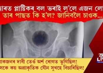 মলদ্বাৰত প্লাষ্টিকৰ বল ভৰাই ল’লে এজন লোকে! তাৰ পাছত কি হ’ল? জানিবলৈ চাওক…