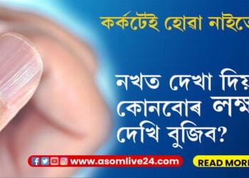 কৰ্কটেই হোৱা নাইতো? নখত দেখা দিয়া কোনবোৰ লক্ষণ দেখি বুজিব?
