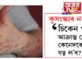 কুসংস্কাৰ নহয়… ‘চিকেন পক্স’ আক্ৰান্ত ৰোগীৰ কেনেদৰে যত্ন ল’ব?