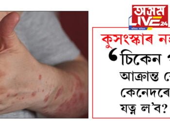 কুসংস্কাৰ নহয়… ‘চিকেন পক্স’ আক্ৰান্ত ৰোগীৰ কেনেদৰে যত্ন ল’ব?
