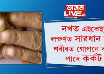 নখত এইকেইটা লক্ষণ দেখিলেই সাৱধান হওক! কৰ্কটৰ লক্ষণে দেখা দিয়ে নখত…