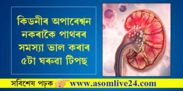 কিডনীত পাথৰ বৃহৎ সমস্যা! কিডনীৰ অপাৰেশ্বন নকৰাকৈ পাথৰৰ সমস্যা ভাল কৰাৰ ৫টা ঘৰুৱা টিপছ