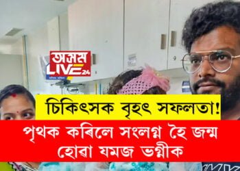 চিকিৎসক বৃহৎ সফলতা! পৃথক কৰিলে সংলগ্ন হৈ জন্ম হোৱা যমজ ভগ্নীক
