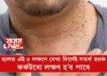 ৫টা লক্ষণঃ ছালত এই ৫ লক্ষণে দেখা দিলেই সতৰ্ক হওক, কৰ্কটৰো লক্ষণ হ’ব পাৰে