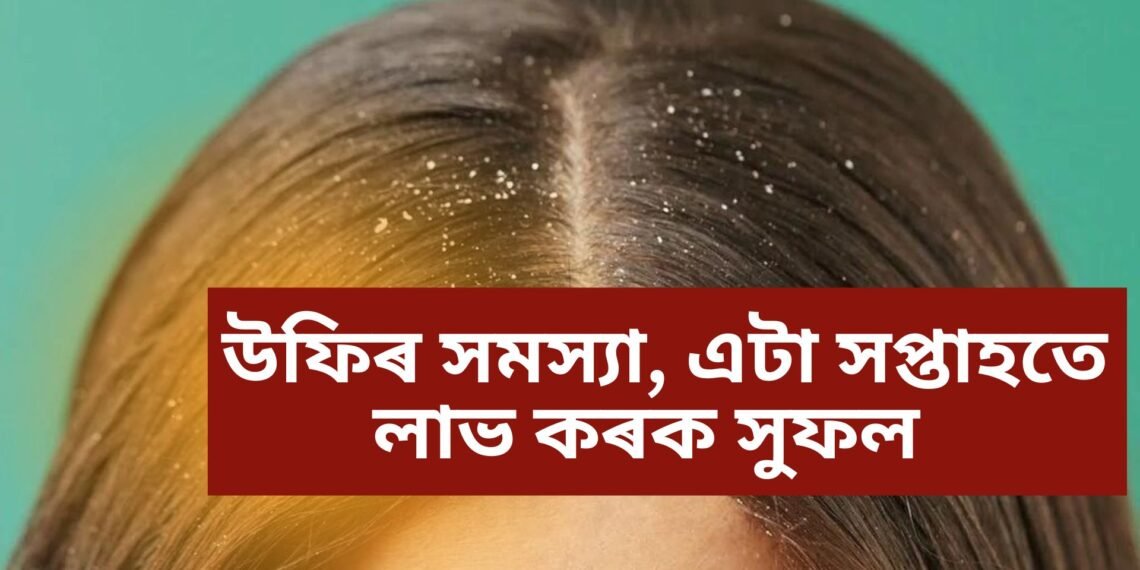 উফিৰ সমস্যা, বহু কৰিয়ো আঁতৰ হোৱা নাই, ব্যৱহাৰ কৰক এই সামগ্ৰী, এটা সপ্তাহতে লাভ কৰক সুফল