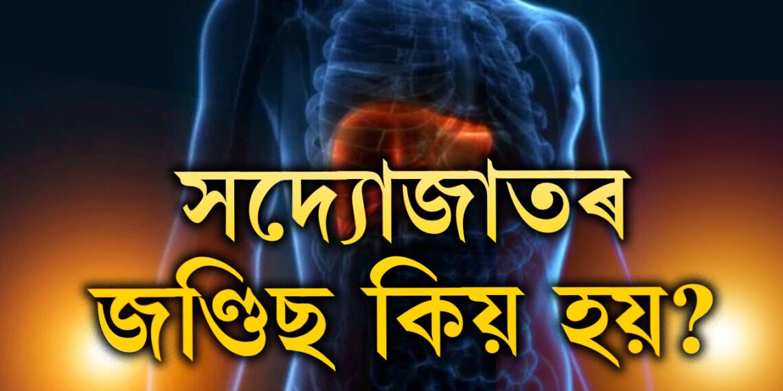 সদ্যোজাতৰ জণ্ডিছ কিয় হয়? কি কি লক্ষণে দেখা দিলে তাৎক্ষণিক চিকিৎসকৰ সহায় ল’ব?