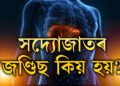 সদ্যোজাতৰ জণ্ডিছ কিয় হয়? কি কি লক্ষণে দেখা দিলে তাৎক্ষণিক চিকিৎসকৰ সহায় ল’ব?