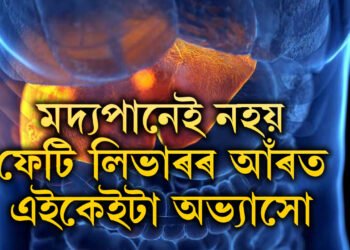 ফেটি লিভাৰ কি? কেৱল ম/দ্ৰপান বন্ধ কৰিলেই এই সমস্যা দূৰ নহয়, ফেটি লিভাৰ ভাল কৰাৰ উপায় কি?