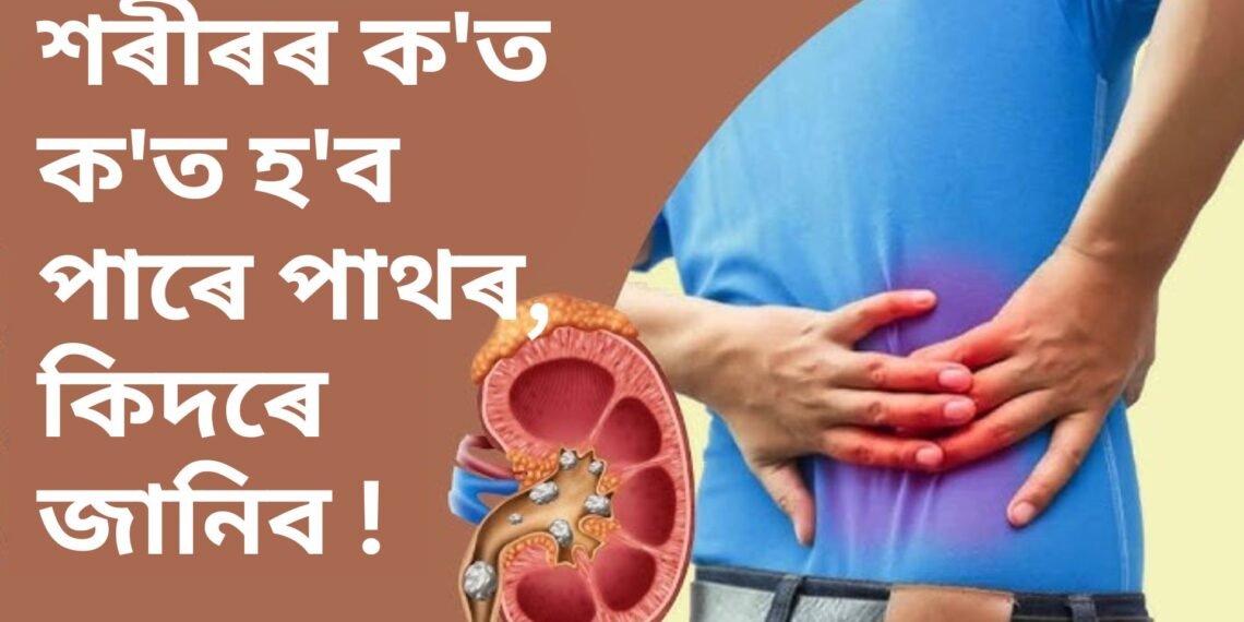 শৰীৰৰ ক’ত ক’ত হ’ব পাৰে পাথৰ, কিদৰে জানিব ! পঢ়ক এই প্ৰতিবেদন-