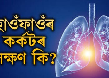 ধূম/পা/ন নকৰিলেও হ’ব পাৰে হাওঁফাওঁৰ কৰ্কট! কি কি উপসৰ্গ দেখিলে সতৰ্ক হ’ব?