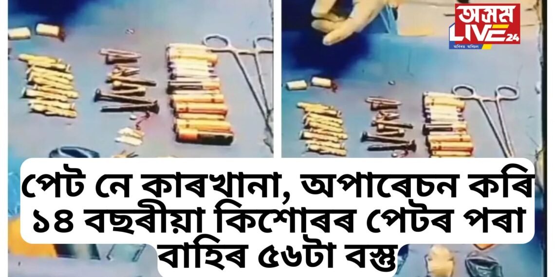 পেট নে কাৰখানা, অপাৰেচন কৰি ১৪ বছৰীয়া কিশোৰৰ পেটৰ পৰা বাহিৰ কৰিলে বেটাৰী, চেইন, স্ক্ৰু, ব্লেডসহ ৫৬টা বস্তু