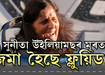 সুনীতা উইলিয়ামছৰ মূৰত ফ্লুয়িড জমা হৈছে! কি অসুবিধা হয় ফ্লুয়িড জমা হ’লে?