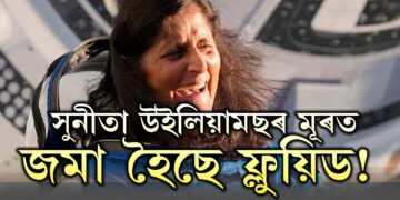 সুনীতা উইলিয়ামছৰ মূৰত ফ্লুয়িড জমা হৈছে! কি অসুবিধা হয় ফ্লুয়িড জমা হ’লে?