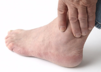 ইউৰিক এছিড বাঢ়িছে, পূৰ্বৰে পৰাই এই সংকেত দিয়ে শৰীৰে, কি কি লক্ষণ দেখিলে সতৰ্ক হ’ব?