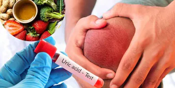 ইউৰিক এছিডৰ মহৌষধ এই ৪ খাদ্য, খালেই দূৰ হ’ব গাঁঠিৰ বিষ