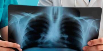 বহুদিন ধৰি কাঁহ হৈ আছে, মাজে মাজে জ্বৰো আছে? যক্ষ্মাৰ লক্ষণ নহয়তো? কি কি পৰীক্ষা কৰাটো জৰুৰী?