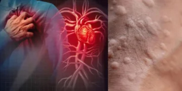 ছালত ফুটি উঠে হাৰ্ট এটেকৰ লক্ষণ! কি কি উপসৰ্গই দেখা দিলে বুজিব হৃদৰোগৰ আক্ৰান্ত হোৱাৰ সম্ভাৱনা আছে?