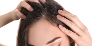 নেমু লগাইয়ো চুলি সৰা আৰু মূৰৰ খজুৱতি কমা নাই? নেমুৰ সৈতে মিহলাই লওক এই উপাদান, ভাল ফল পাবই