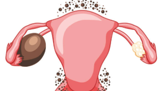 ওজন বাঢ়িলেই জৰায়ুত চিষ্টৰ আশংকা বাঢ়ে নেকি? চিষ্ট হোৱাৰ সম্ভাৱনা কাৰ বেছি? কোন বয়সৰ নাৰী সাবধান হ’ব?