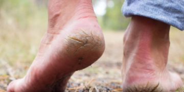 শীতকালত খুবেই ভৰিৰ গোৰোহা ফাটে? কেৱল বাহ্যিক যত্ন নহয়, শৰীৰত এই ভিটামিনৰ ঘাটি দূৰ কৰিলেহে কমিব এই সমস্যা