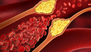 কলষ্টেৰল বাঢ়িছে? শিৰাসমূহত জমা হৈ থকা বেয়া কলষ্টেৰল দূৰ কৰিবলৈ প্ৰতিদিনে খাদ্যভাষত ৰাখক এইকেইবিধ পাচলি