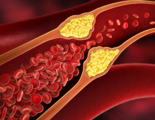 কলষ্টেৰল বাঢ়িছে? শিৰাসমূহত জমা হৈ থকা বেয়া কলষ্টেৰল দূৰ কৰিবলৈ প্ৰতিদিনে খাদ্যভাষত ৰাখক এইকেইবিধ পাচলি
