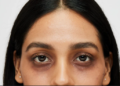 dark circleৰ সমস্যাৰ কেনেকৈ কৰিব সমাধান?