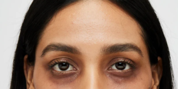 dark circleৰ সমস্যাৰ কেনেকৈ কৰিব সমাধান?