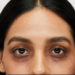 dark circleৰ সমস্যাৰ কেনেকৈ কৰিব সমাধান?